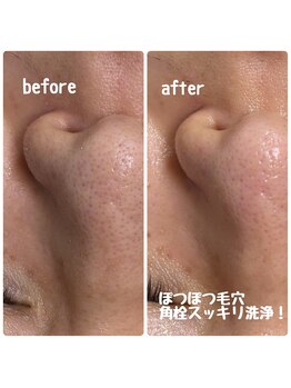 クラリ(Clari)/毛穴/毛穴洗浄/ハイドラ