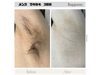 ラポール(rappore;)/メンズワキ脱毛