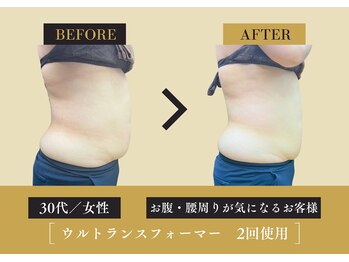 キレイ 筑紫野原田店(KIREI)/30代 お腹・腰周りが気になる