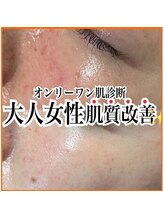 エステ ココ 土気店(Esthe CoCo)/#シミ#くすみ#たるみ#肌質改善