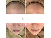 リノ(Lino)の雰囲気（もう傷つかないで！悩まないで！ニキビ肌から卒業できます♪）