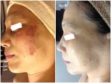 ルノン(LUNON)/ビフォーアフター集