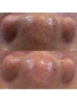 バイカラー(BY COLOR)/メンズ　毛穴洗浄