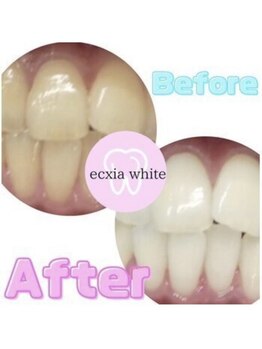 エクシアホワイトニング 静岡駅前店/ビフォーアフター