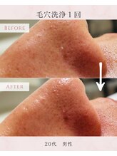ル シャ/メンズ脱毛/毛穴洗浄/ヘッドスパ