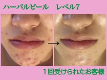 エステサロン ジジ 新宿(JIJI)の雰囲気(ハーバルピール(本格ハーブピーリング)、初回11000円~ /新宿)