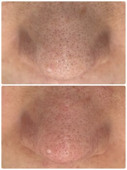 アール(R)/【 毛穴洗浄 】 オプション