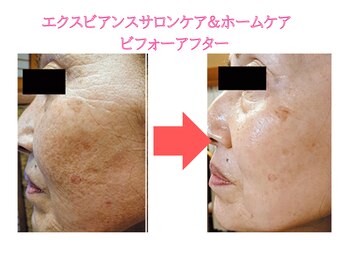 ソフィア ミューズ 目黒/水光ピーリングでシワくすみ改善