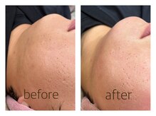 ペルボヌール 深井店/脂肪分解(REDSHOT)