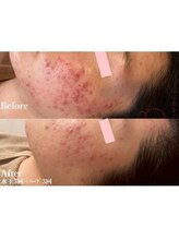 ヴェアリー 広尾(VARY)/水玉5回ハーブ3回