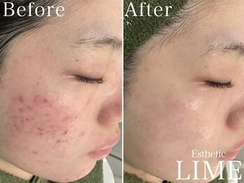 ライム 新宿三丁目(LIME)/ハーブピーリング|ニキビケア