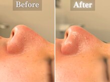 ボーンオム(Born Homme)/毛穴洗浄＋美容液導入：20代女性