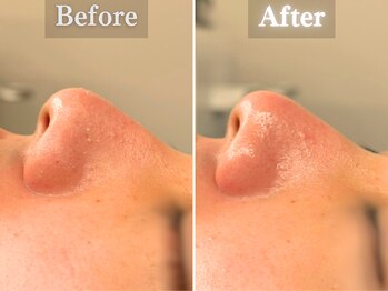 ボーンオム(Born Homme)/毛穴洗浄＋美容液導入：20代女性