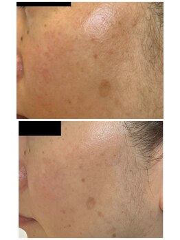 ミラヴィエ(Miravie)/シミケア！薬用の力で変わる！