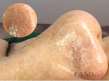 キャンディ 天王寺(CANDi)/ハイドラピーリング黒ずみ毛穴◎