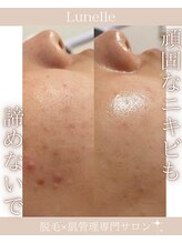 ルネル(Lunelle)/Noコンシーラー！Yesすっぴん！