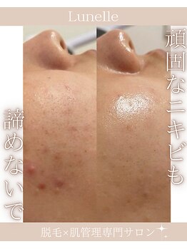 ルネル(Lunelle)/Noコンシーラー!Yesすっぴん!