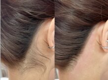 アイラブワン(eye love one)/うなじワックス脱毛【脱毛】