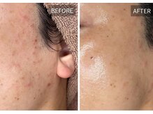 エナ(ENA)/ララピール「韓国肌管理」