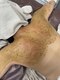 エピュール(Epurer)の写真/大切な日を最高の状態で迎えたいあなたへ。背中ニキビを改善し、自信の持てるドレス姿を叶えましょう◎