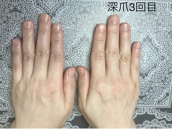 桃の木 吉祥寺店/爪のお悩み[深爪] 3回目