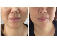 はんなり/テラボーラー、ビフォーアフター