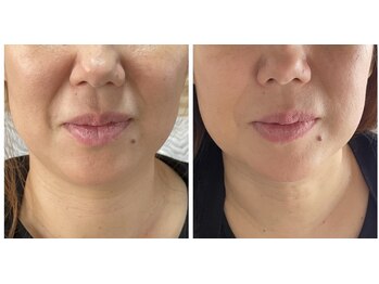 はんなり/テラボーラー、ビフォーアフター