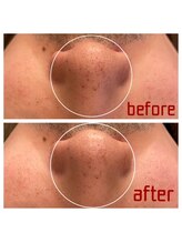 アクアプラス(AQUA+)/20代男性　ハイドロ１回