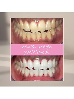 エクシアホワイトニング 四日市店/ホワイトニングビフォーアフター