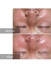 ヒヨリ(hiyori)/《before/after》毛穴洗浄