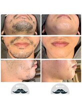 ワンケーヴ(onecave)/髭脱毛