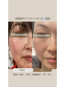 ブロッサム(Blossom)/韓国式白雪肌スノーピーリング