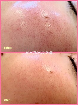 ミレボ(Me.rebo)/ハーブピーリング1回のB→A