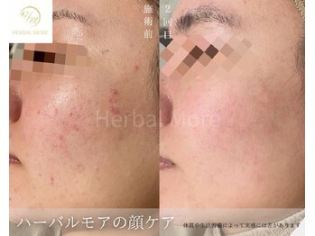 スキニティ 池袋(sknity)/<フェイシャル>キメ整えクリア肌