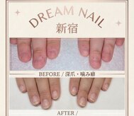 【深爪矯正・自爪育成専門店】Dream Nail 新宿