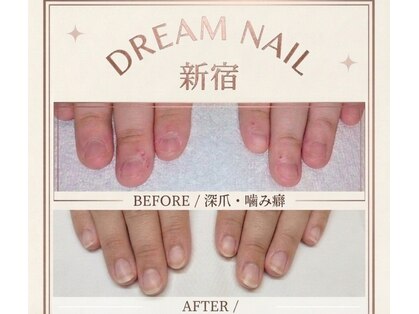 【深爪矯正・自爪育成専門店】Dream Nail 新宿の写真