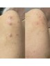 【メンズ肌ケア】ニキビ・毛穴・ザラつきに★ハーブピーリング