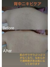 サロンエム(Salon m)/背中ニキビケア