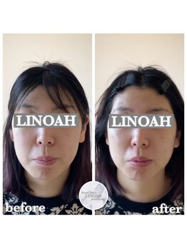 リノア 心斎橋店(LINOAH)/ウルトラプラス小顔リフト b→a