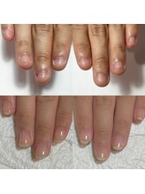 セラキュアネイル(Theracure nail)/深爪緩和で美爪に育みます