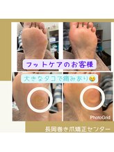 長岡巻き爪矯正センター/フットケアビフォーアフター