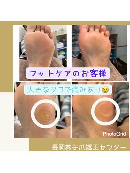 長岡巻き爪矯正センター/フットケアビフォーアフター