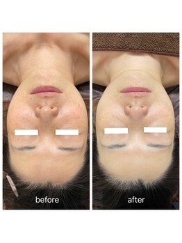 メロウゴールド(Mellow Gold)/剥離なし幹細胞ハーブピーリング