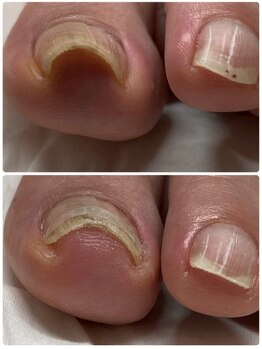 フット/ネイルケア/巻き爪矯正