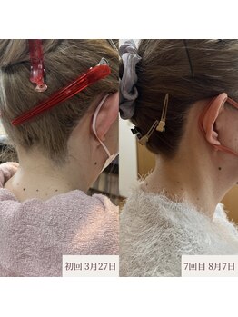 クラームビューティー(Clerm beauty)/美容師によるうなじデザイン脱毛