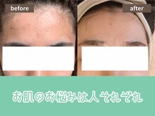 キザシ(kizashi)/にきび改善☆