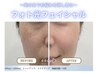 【7月15日~】フォト光フェイシャル初回11,000円→3,000円★