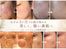 アイデアル(AiDEAL)の雰囲気（毛穴/ニキビ/ハーブピーリング/赤み/敏感肌/シミ《沖縄/浦添》）