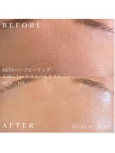 フローレ 豊田店(Flore)/毛穴詰まり・開きが気になる方へ