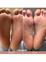 マオヌー(MAONU)/韓国式足裏角質ケア　症例写真